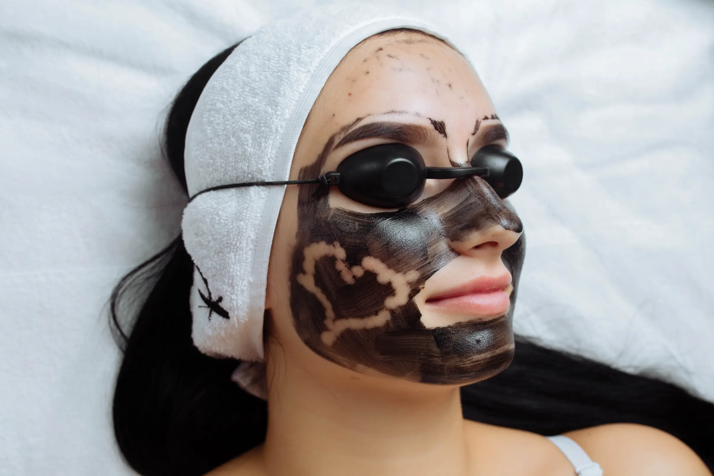 Close-up of a woman with a carbon mask on her face, wearing protective eyewear, during a carbon laser peel treatment.