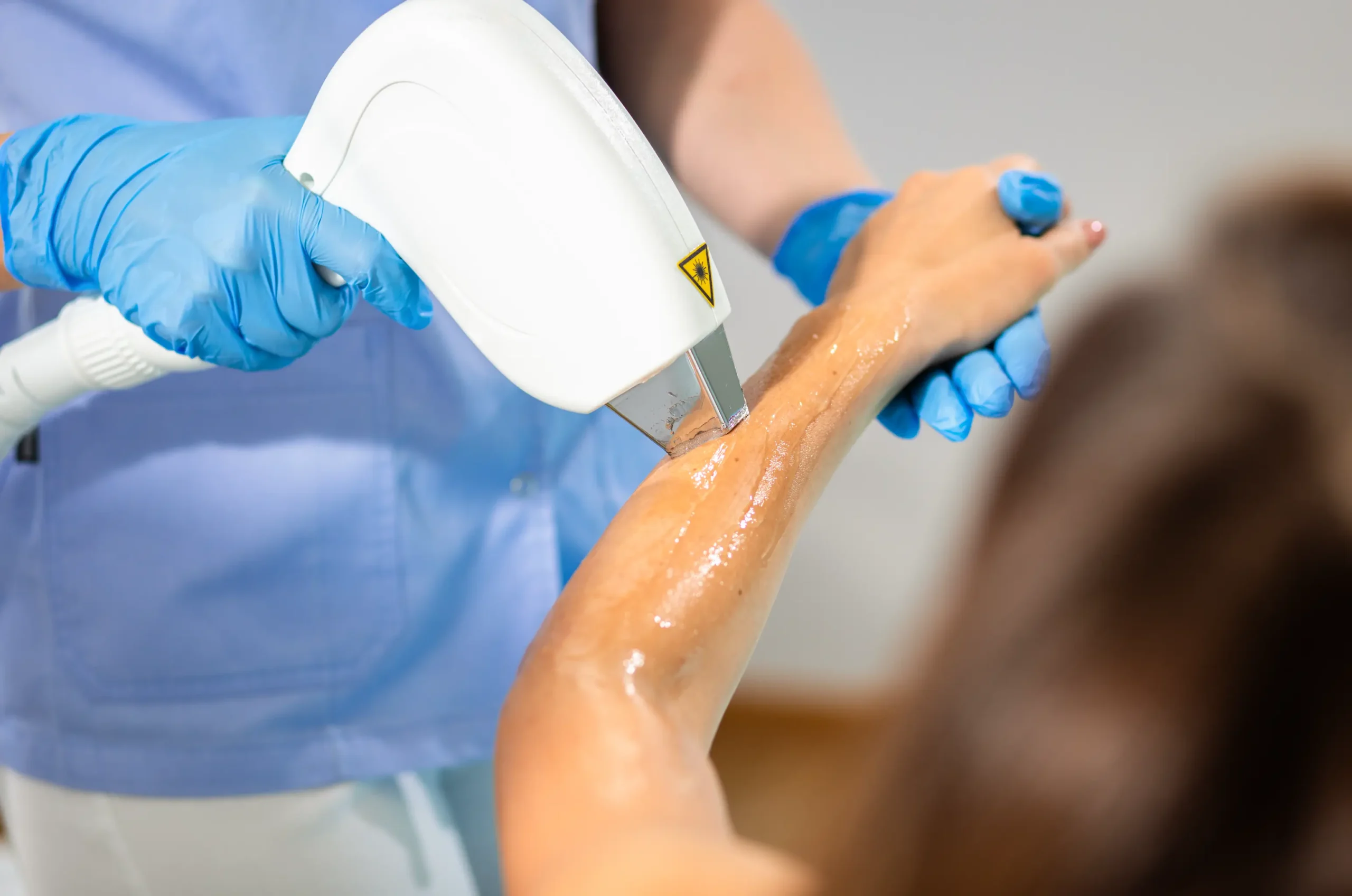 Laser hair removal treatment being administered by a professional, highlighting the precision and care involved in the procedure.