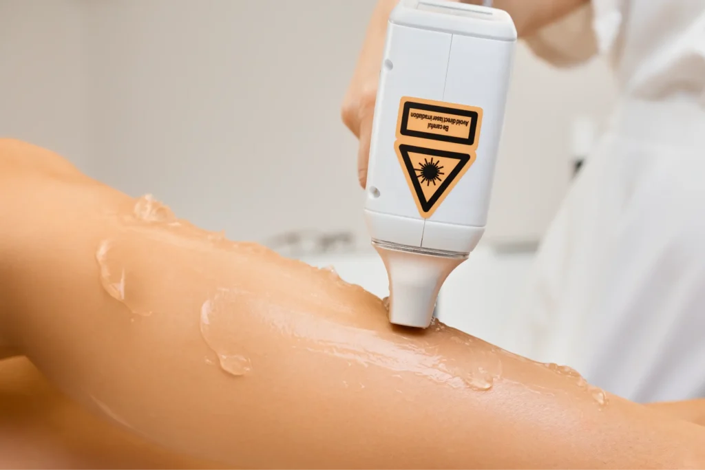 Close-up of a leg undergoing hair removal laser treatment. The advanced system like Primelase uses cooling technology to minimize discomfort while delivering effective results. Hair Removal Laser doesn't have to be painful anymore.