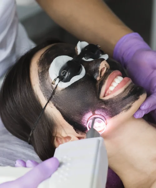 A smiling client with a carbon mask on their face is undergoing a Carbon Laser Peel (also known as the Hollywood Peel).